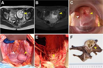 Case report: Rare heterozygous variant in the NR5A1 gene causing 46,XY complete gonadal dysgenesis with a non-communicating rudimentary uterus